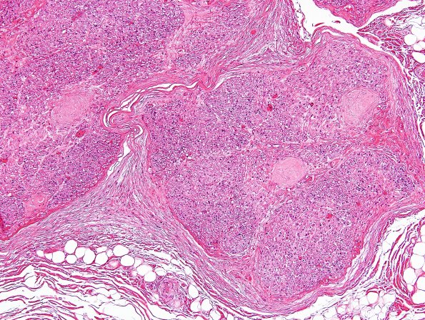 6A1 Renaut body (CIDP, Case 6) L Brachial Plexus H&E 7