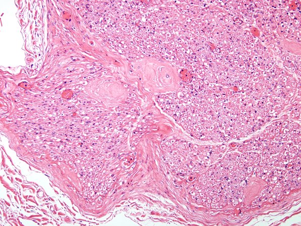 6A3 Renaut body (CIDP, Case 6) L Brachial Plexus H&E 3