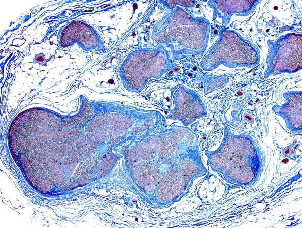 6B1 Renaut body (CIDP, Case 6) L Brachial Plexus Trichrome 6