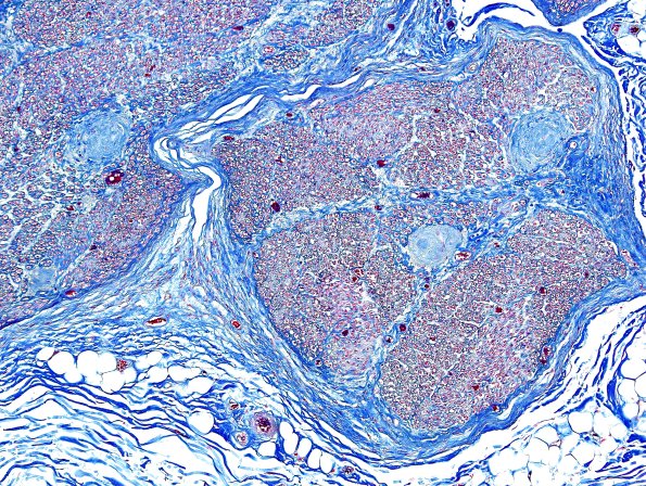 6B2 Renaut body (CIDP, Case 6) L Brachial Plexus Trichrome 5