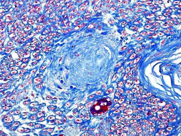 6B3 Renaut body (CIDP, Case 6) L Brachial Plexus Trichrome 2