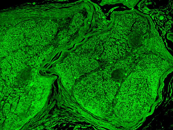 6C1 Renaut body (CIDP, Case 6) L Brachial Plexus Thio-S 5