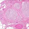 1A5 Nl sural H&E (Case 4) 2