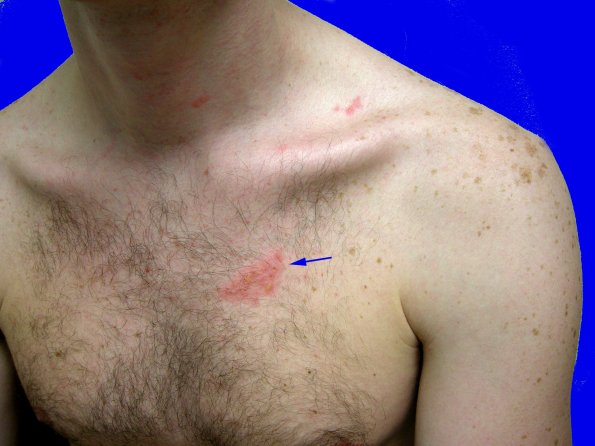 1A1 Shingles (thanks to Milan Anadkat, MD)A copy