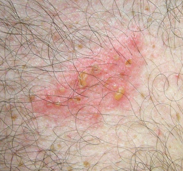 1A2 Shingles (thanks to Milan Anadkat, MD)A