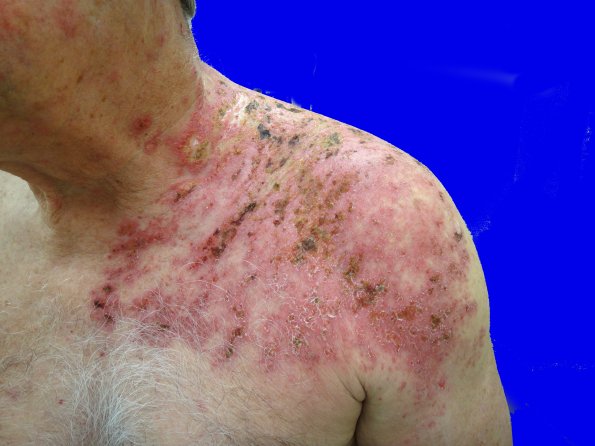 1B1 Shingles (thanks to David M Sheinbein, MD)A