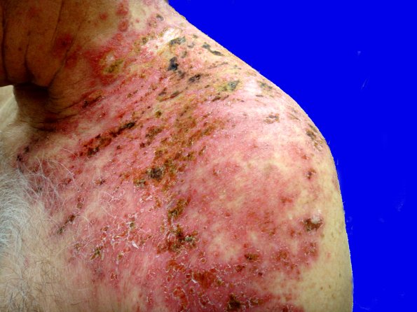 1B2 Shingles (thanks to Milan Anadkat, MD)A