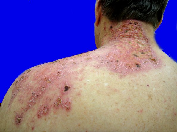 1B3 Shingles (thanks to David M Sheinbein, MD, DSC00018)a