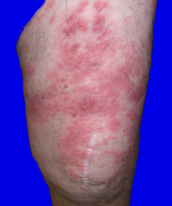 1C Shingles (thanks to Milan Anadkat MD) A