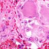 2A10-Varicella-Zoster-Case-2-DRG-H-E-3.jpg