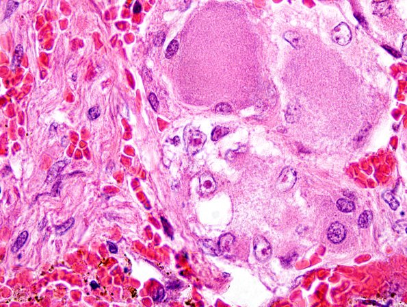 2A10-Varicella-Zoster-Case-2-DRG-H-E-3.jpg