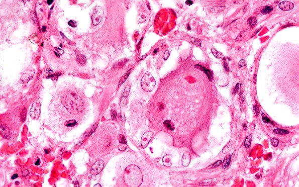 2A11 Zoster (Case 2) 31