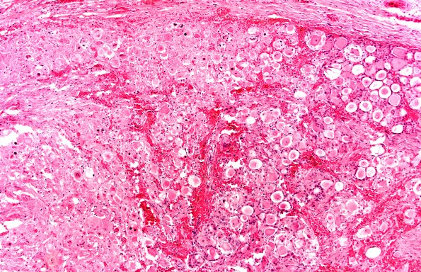 2A2 Zoster DRG (Case 2) H&E 10X 1a