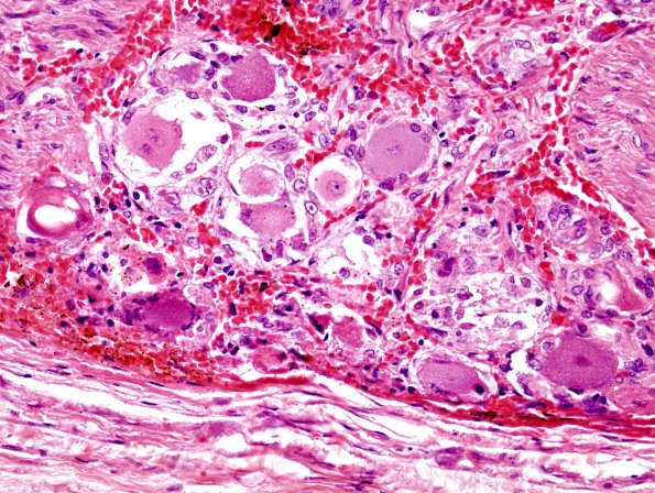 2A6 Zoster DRG (Case 2) H&E 2 (2)