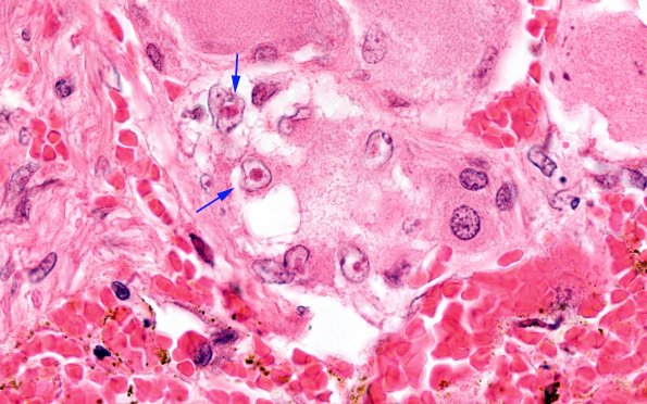 2A7 Zoster (Case 2) 23 copy