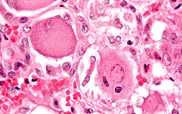 2A8 Zoster (Case 2) 25