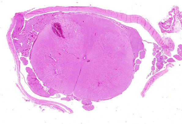 2B1 Zoster myelitis (Case 2) Zoster myelitis (ts) 3