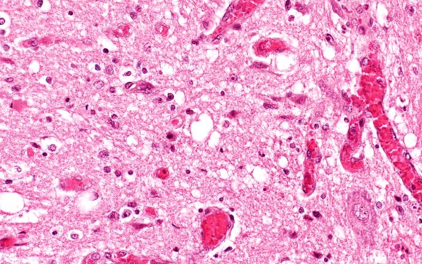 2B3A Zoster myelitis (Case 2) Zoster myelitis (ts) 40X 1