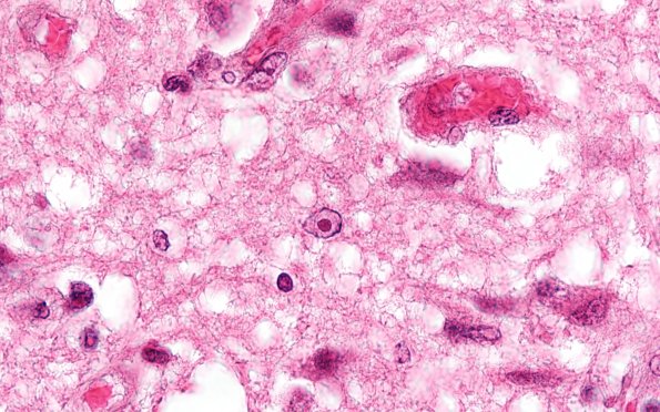 2B3B Zoster myelitis (Case 2) Zoster myelitis (ts) 100X 1