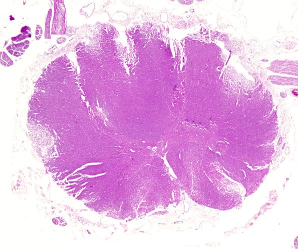2C1 Zoster myelitis (Case 2) WM 2