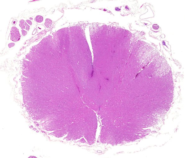 2C2 Zoster myelitis (Case 2) WM 1