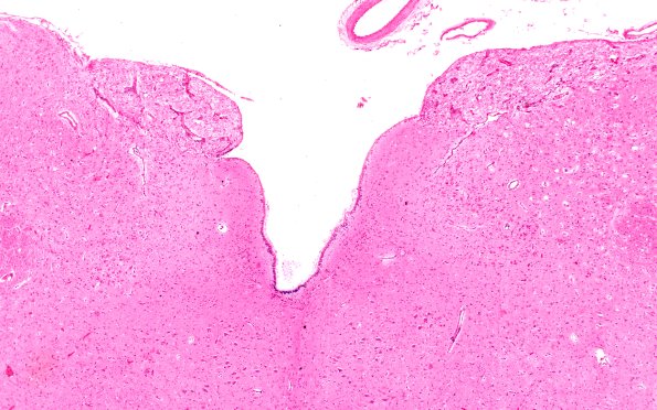 2D1 Varicella (Case 2) H&E 5