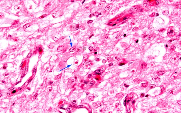 2D3 Varicella (Case 2) H&E 8 copy