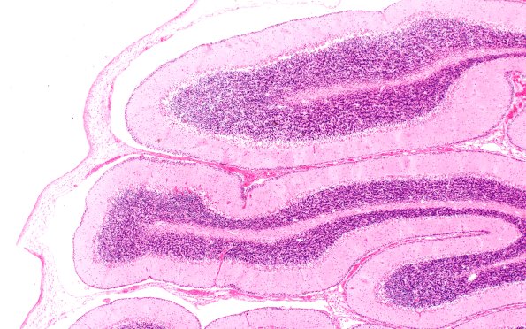 2E1 Varicella (Case 2) H&E 1