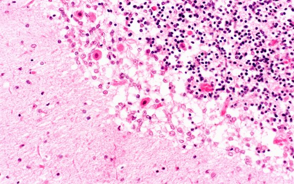 2E2 Varicella (Case 2) H&E 3