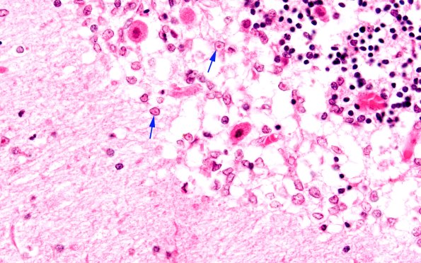 2E3 Varicella (Case 2) H&E 4 copy