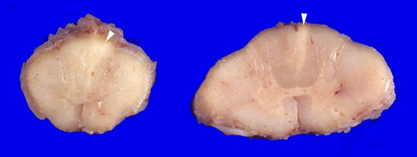 3A1 Zoster, Herpes (Case 3) 1A gross 2 copy