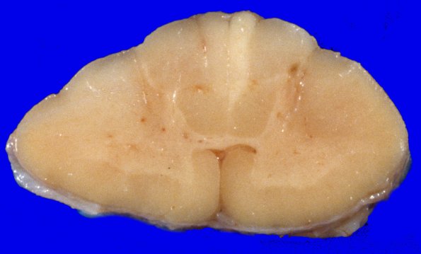 3A2 Zoster (Case 3) 1