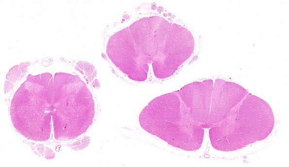 3B1 Zoster cord (Case 3) 2