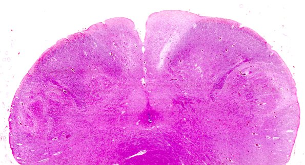 3B3 Zoster cord (Case 3) Medulla