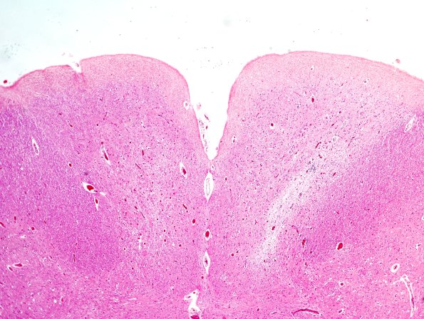 3B4 Zoster cord (Case 3) 3