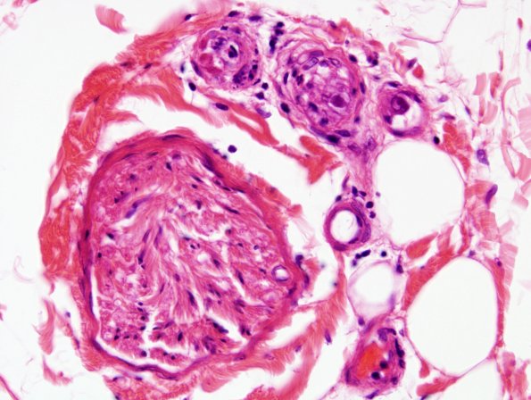 1A2A CMV Neuritis in AIDS (Case 1) H&E 10