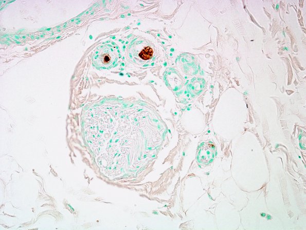 1A2B CMV Neuritis in AIDS (Case 1) ImmunoCMV 15A