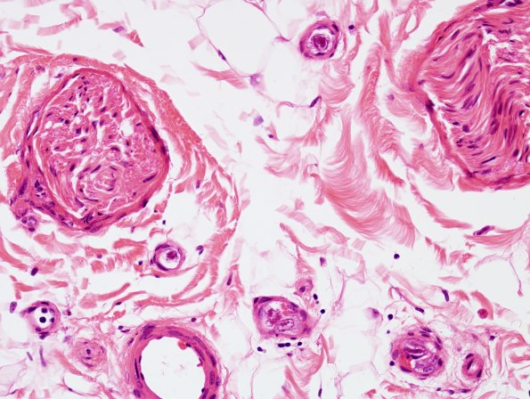 1A4 CMV Neuritis in AIDS (Case 1) H&E 14