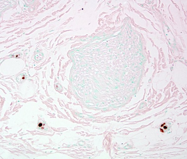 1B1 CMV Neuritis in AIDS (Case 1) ImmunoCMV 6