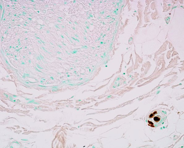 1B2 CMV Neuritis in AIDS (Case 1) ImmunoCMV 2