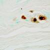 1B3 CMV Neuritis in AIDS (Case 1) CMV immunostain 100X 1