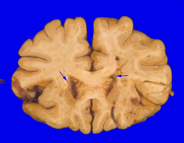 2A1 CMV (Case 2) Gross 4 copy
