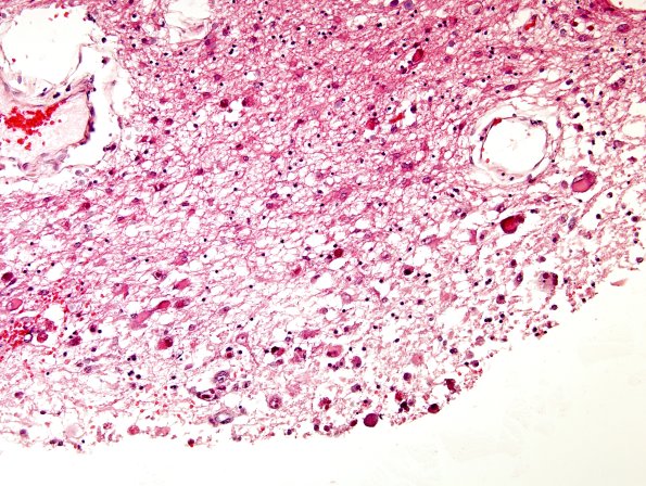 2B1 CMV (Case 2) Ependymitis H&E 1