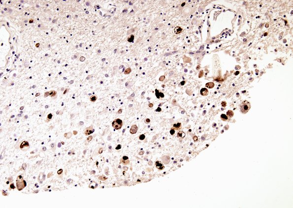 2C1 CMV (Case 2) Ependymitis CMV