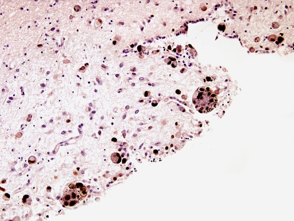 2C2 CMV (Case 2) Ependymitis CMV2