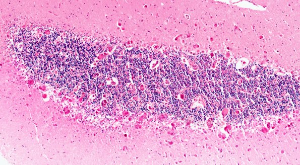 2D1 CMV (Case 2) N9a H&E 4A