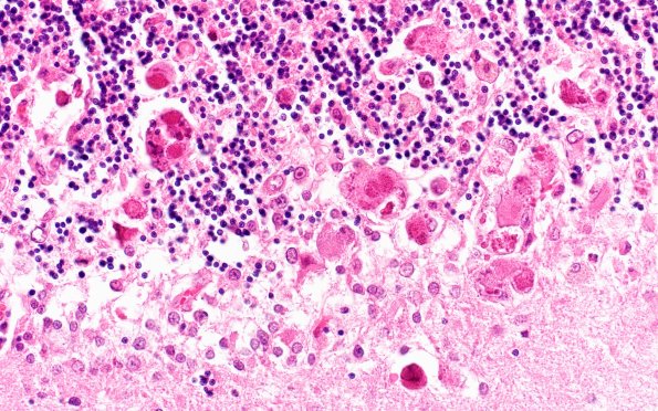 2D2 CMV (Case 2) N9a H&E 2