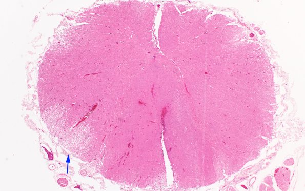 2E1 CMV (Case 2) Spinal cord 2X copy