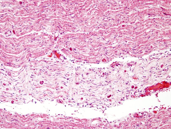 2F1 CMV Neuritis in HIV (Case 2) H&E 3