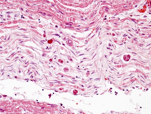 2F2 CMV Neuritis in HIV (Case 2) H&E 2
